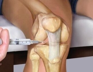 Infiltrazioni di Cortisone: LA FINE DI UN ERA